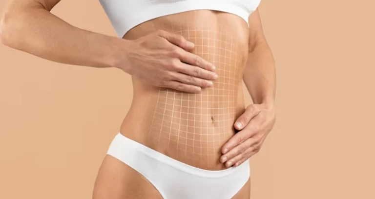 Abdominoplastia